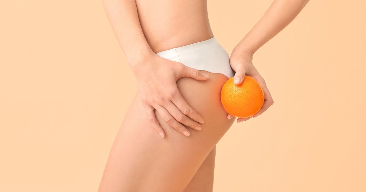 Radiofrequenza per la cellulite