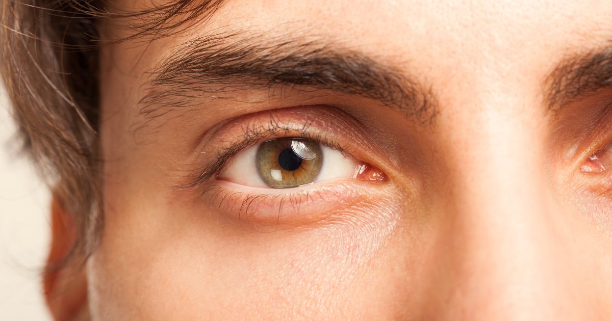 Trattamento occhiaie